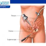 Which tool is used for laparoscopic cholecystectomy?