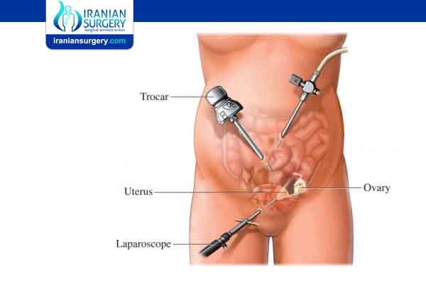Which tool is used for laparoscopic cholecystectomy?