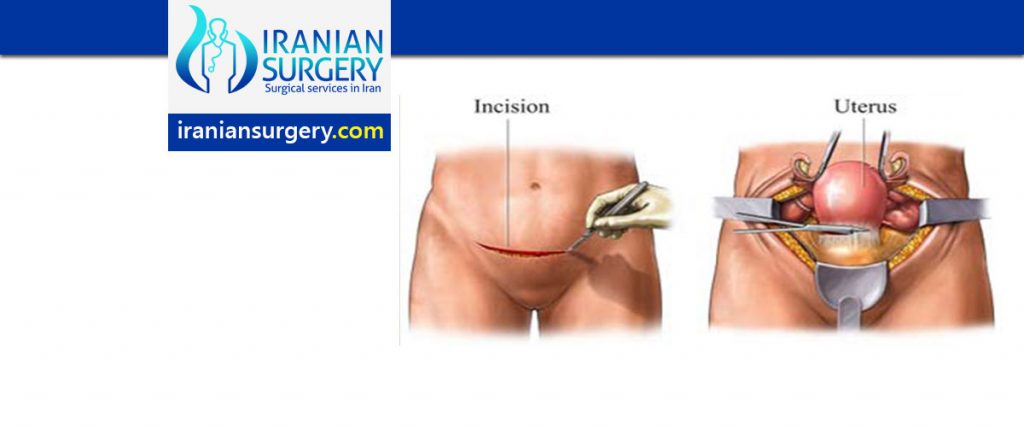 abdominal hysterectomy steps