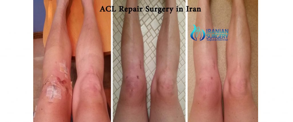 acl repair surgery cost in iran