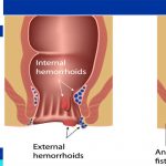 anal abscess treatment in iran