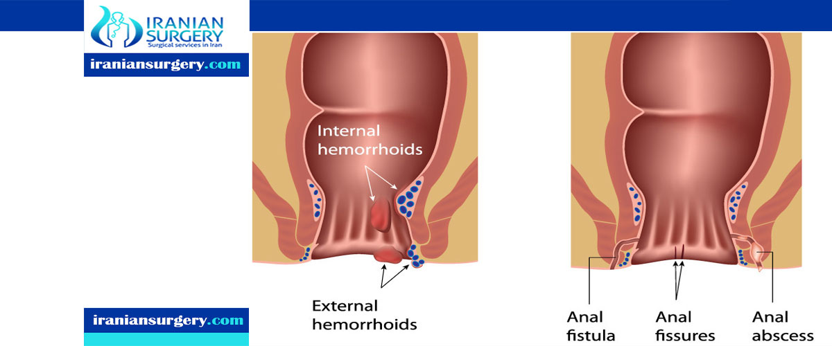 Anal treatment