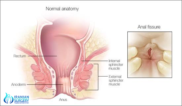 anal fissure surgery in iran