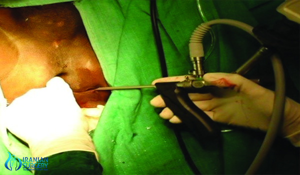 anal fistula surgery in iran