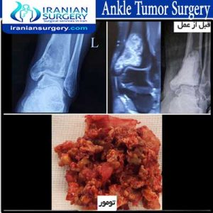 ankle tumor surgery abolghasemzadeh