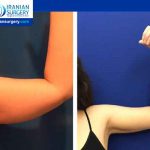 arm liposuction