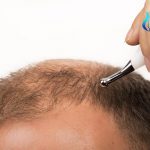 Best hair transplant method