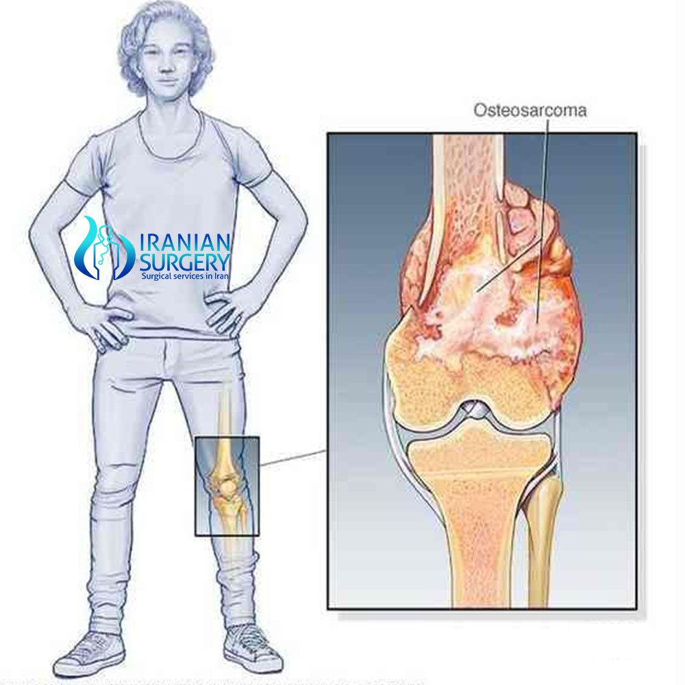 bone cancer treatment in iran m