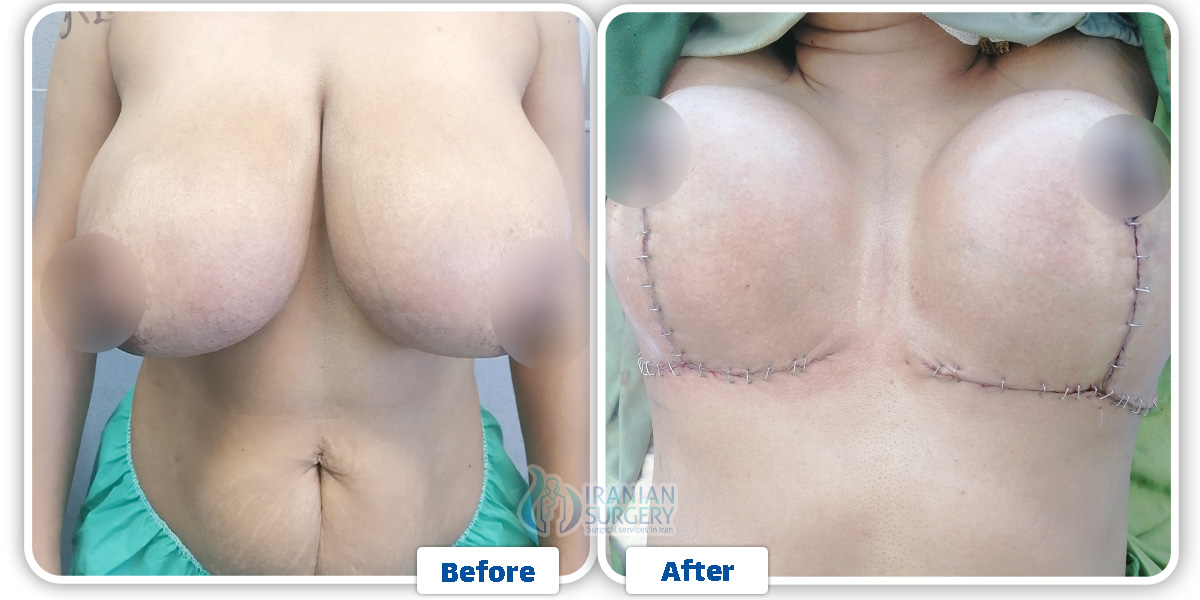 Breast surgery in Iran