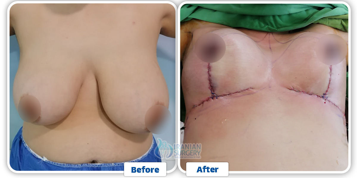 Breast surgery in Iran