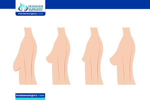 breast lift cost in iran