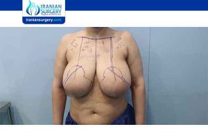 breast reduction in Iran