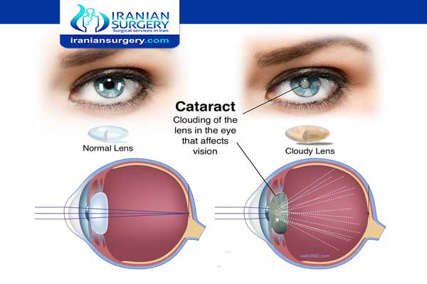 cataract surgery procedure