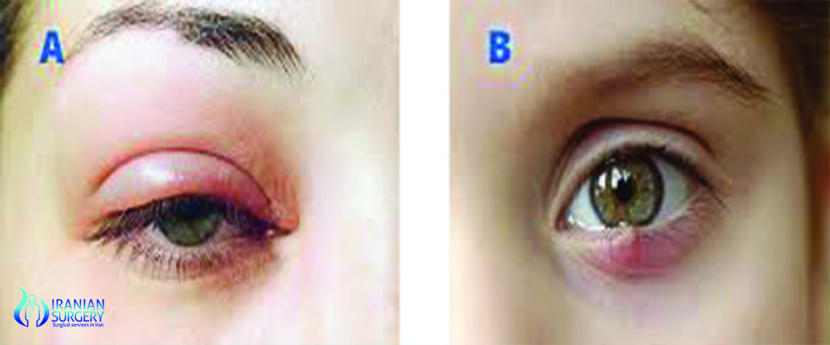 Chalazion treatment Iran 2019|Chalazion cost Iran vs india| Iranian Surgery