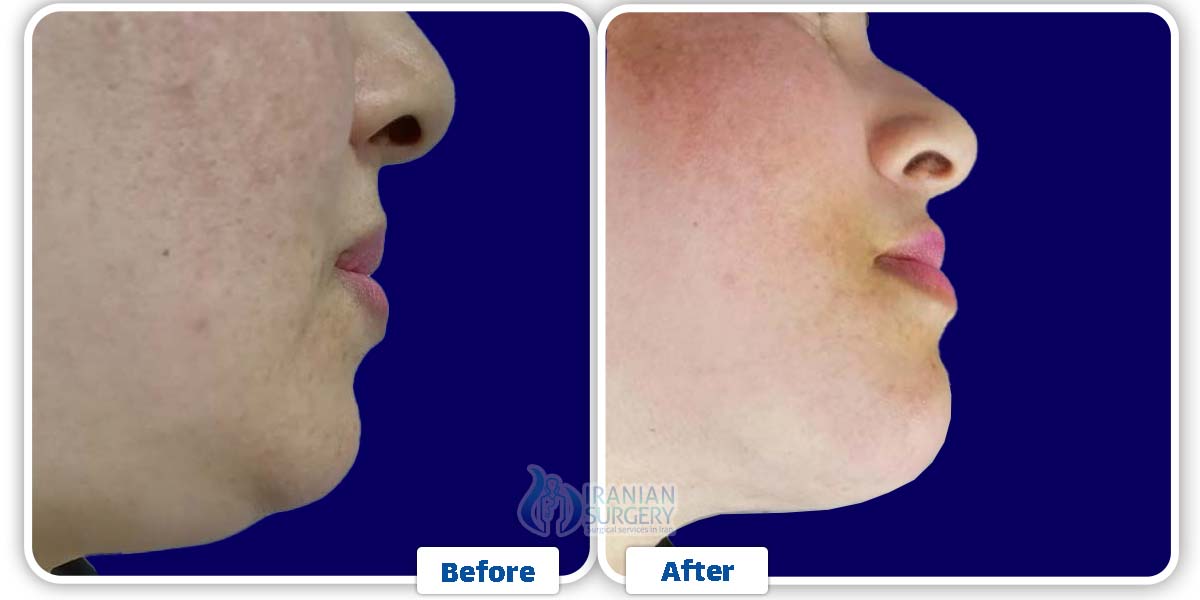 Chin Liposuction