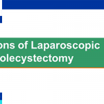 cholecystectomy indications