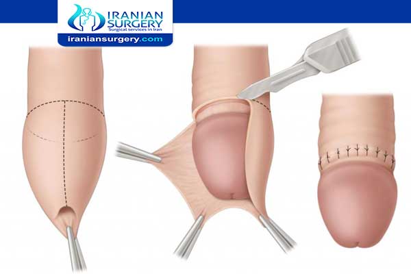 circumcision surgery in Iran
