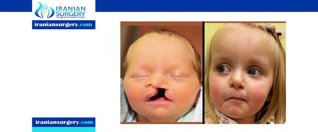 cleft palate surgery ideal age