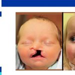 cleft palate surgery ideal age