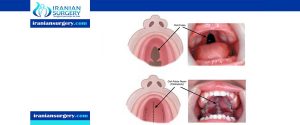 cleft palate surgery time