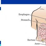 colectomy surgery complications