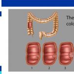 colorectal cancer treatments