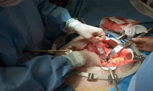 colorectal surgery
