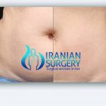 coolsculpting