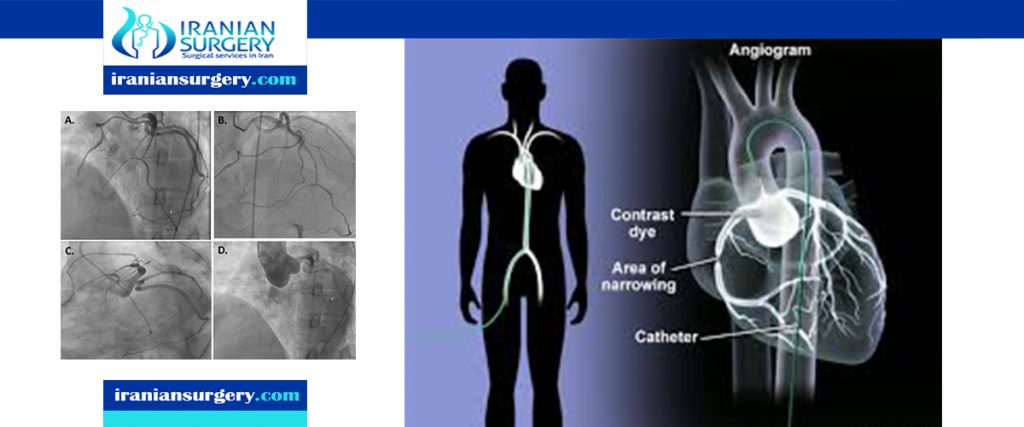 coronary angiogram procedure in iran