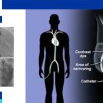 coronary angiogram procedure in iran