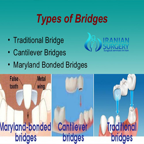 dental bridge cost iran