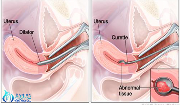 dilation and curettage procedure steps in Iran