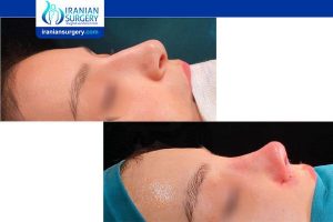 nosejob with dr mosleh4