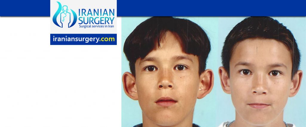 Otoplasty (Ear reshaping surgery) in Iran