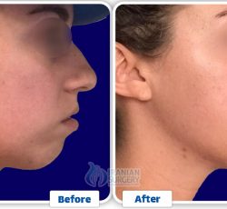 Chin Liposuction 3