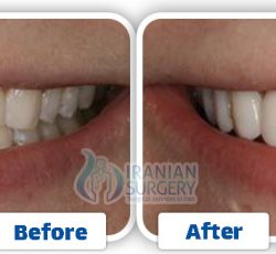 Dental Veneers in Iran