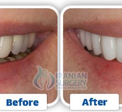 Dental Veneers in Iran