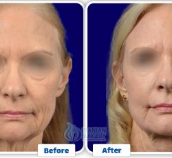 Facelift Surgery In Iran