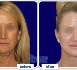 Facelift Surgery In Iran