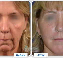 Facelift Surgery In Iran 3