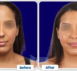 Forehead Contouring Surgery In Iran 1