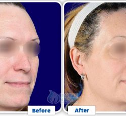 Forehead Contouring Surgery In Iran 2