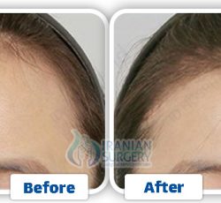 Forehead Contouring Surgery In Iran