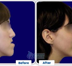 Jaw Surgery In Iran