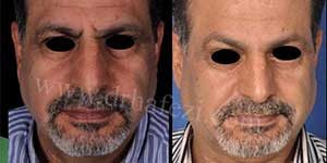 plastic surgery in iran