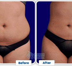 Vaser Liposuction In Iran 2