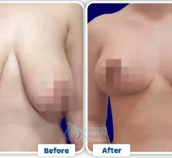 b&a breast lift2