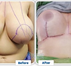 ba breastlift 3 qv75i00zplkiarr1finyv5h5zjknwpc32fmpwpbv5o