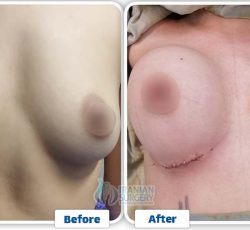 ba breastlift 5