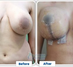 b&a breastlift 6